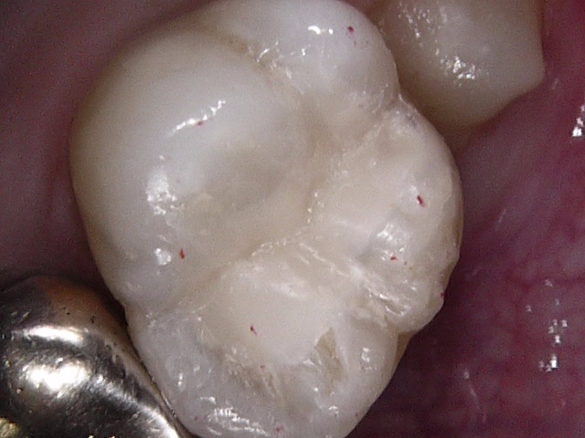 虫歯症例1治療後