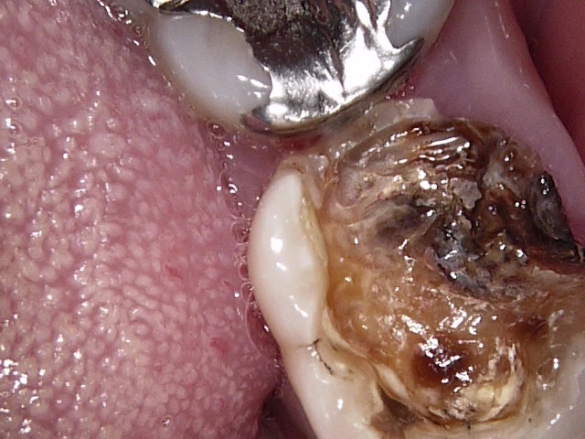 虫歯症例2治療前