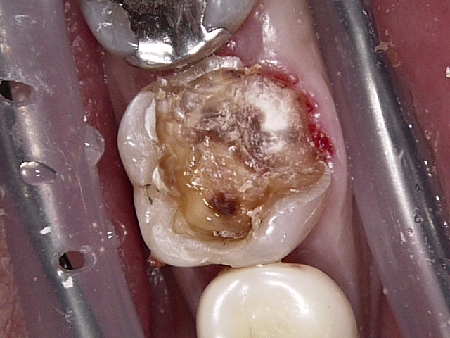 虫歯症例2治療中