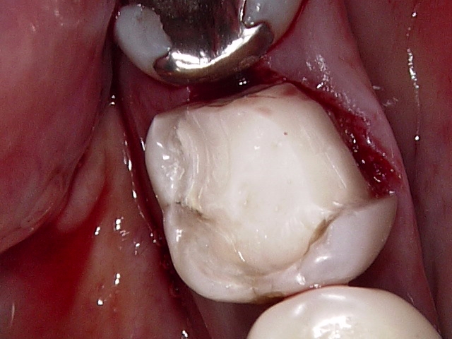 虫歯症例2治療後