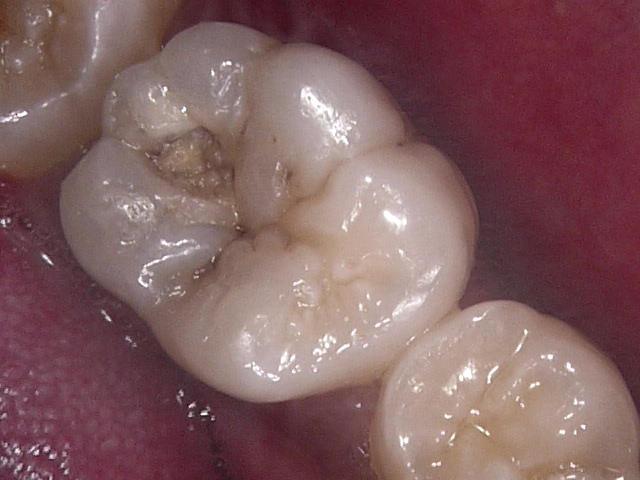 虫歯症例3治療前