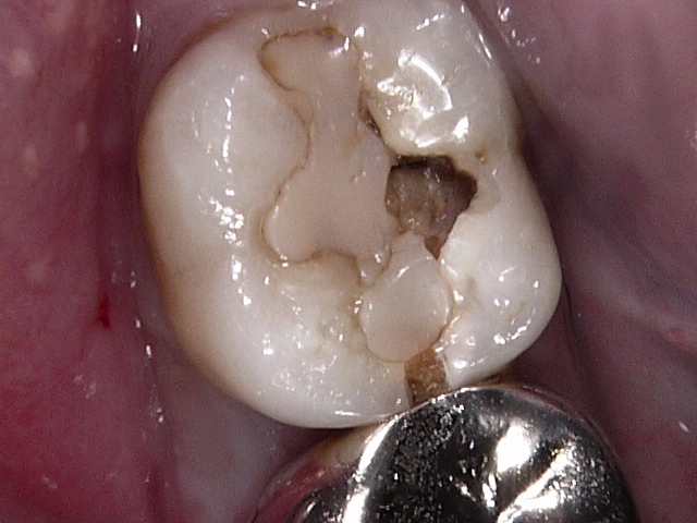 虫歯症例4治療前