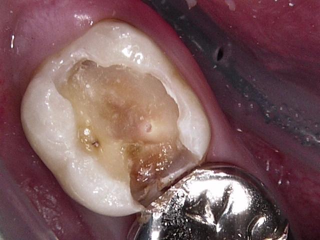虫歯症例4治療中