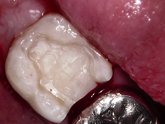 虫歯症例4治療後