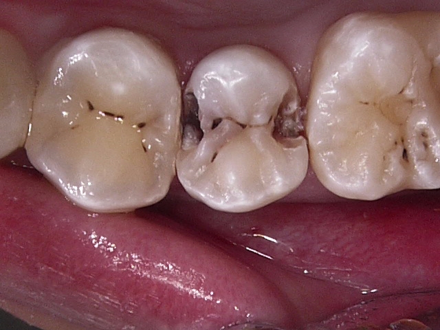虫歯症例4治療中