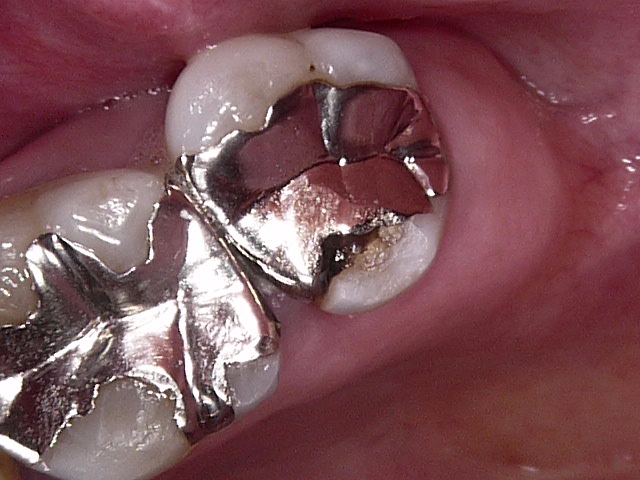 虫歯症例6治療前